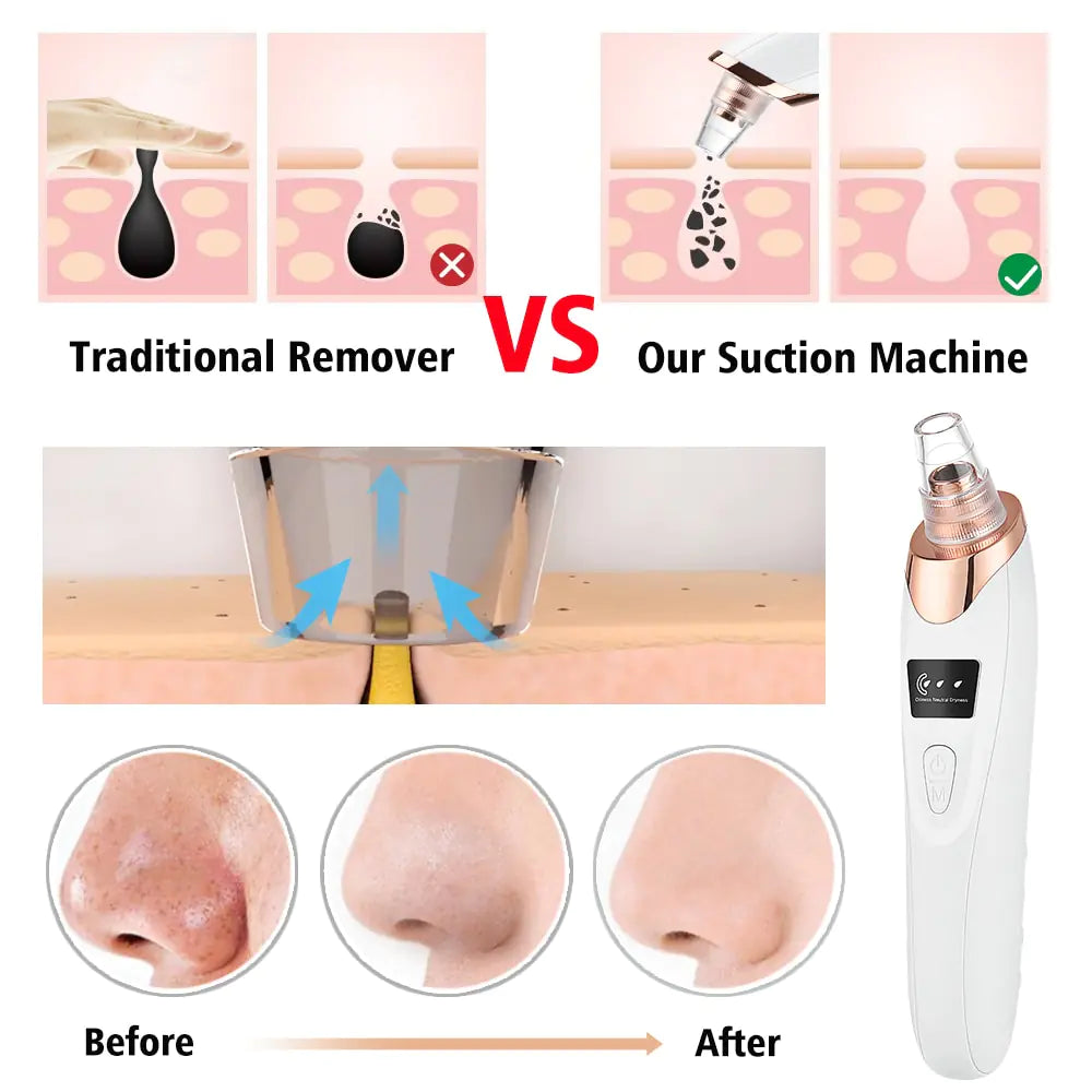 Marcival Hill ClearSkin Pro - Blackhead Remover