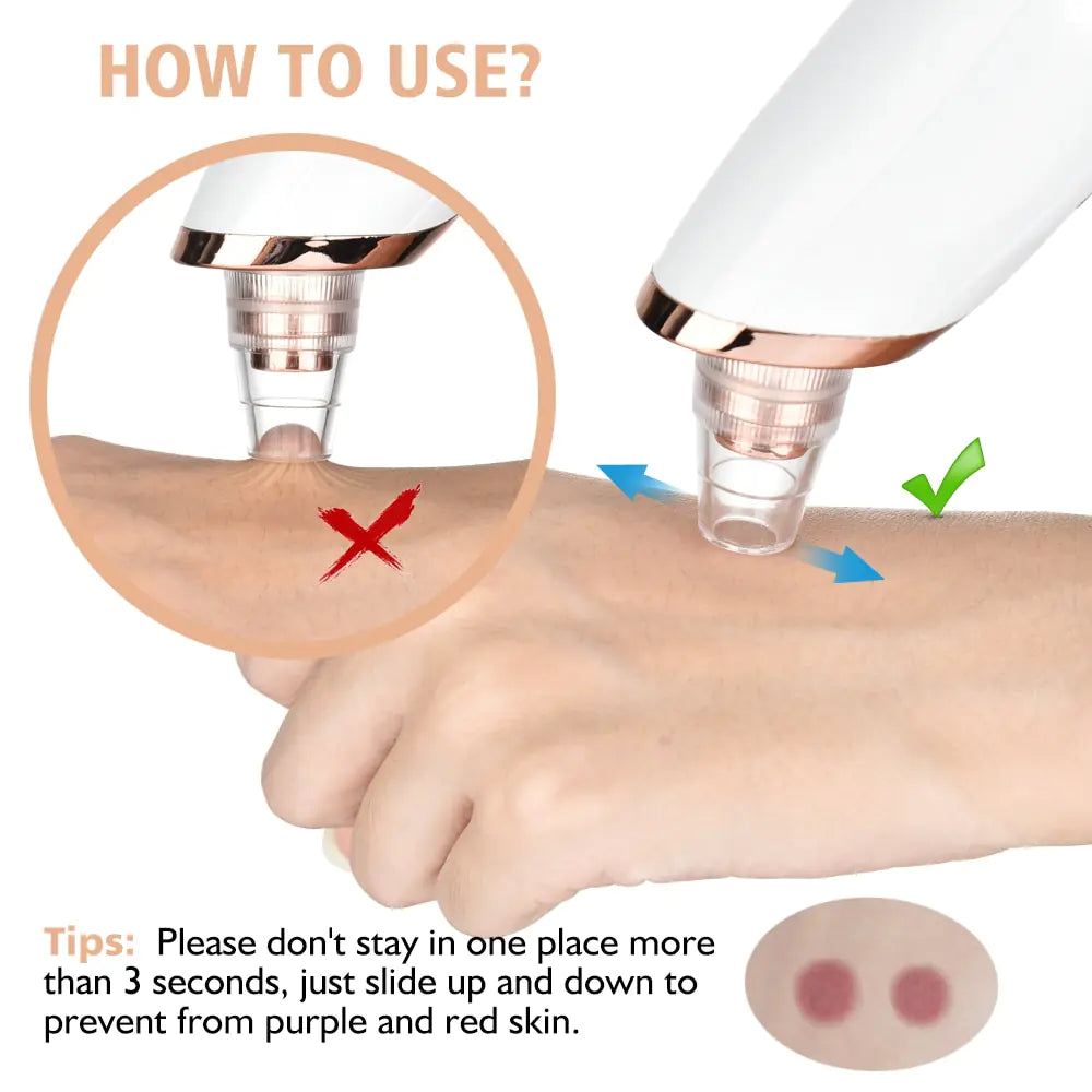 Marcival Hill ClearSkin Pro - Blackhead Remover